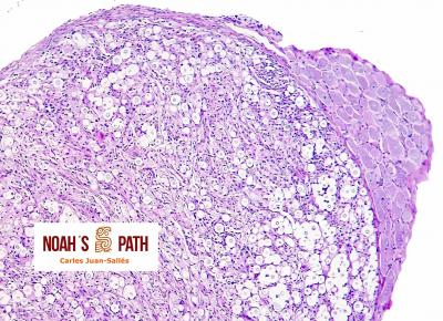 Radiculoneuritis por criptococosis