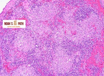 Esplenitis piogranulomatosa por coronavirus sistémico