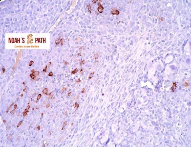 Enteritis piogranulomatosa - inmunohistoquímica coronavirus