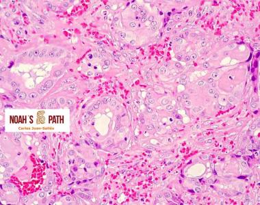 Adenocarcinoma tiroideo