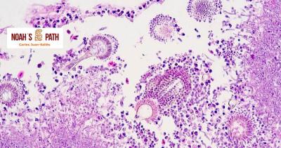 Aerosaculitis aspergilosis