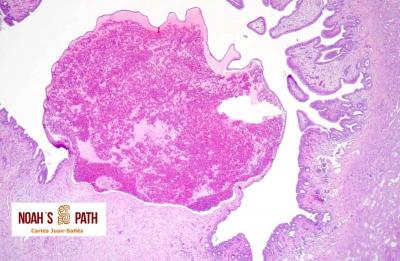 Aneurisma venoso endometrial