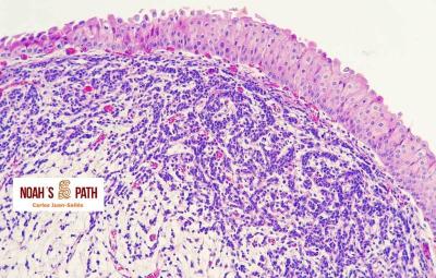 Carcinoma epitelio transición - vegija orina