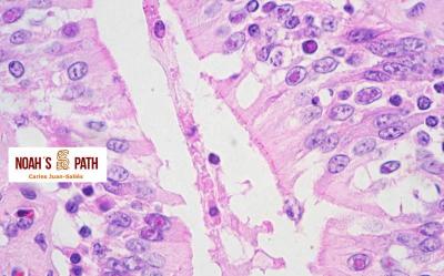 Coccidiosis intranuclear - intestino