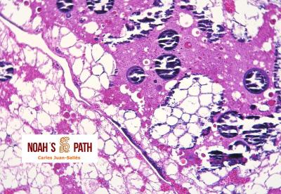 Mineralización de saco vitelino