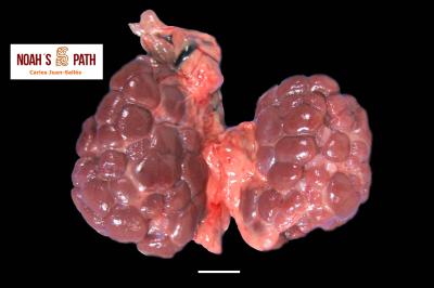 Riñones multilobulados normales