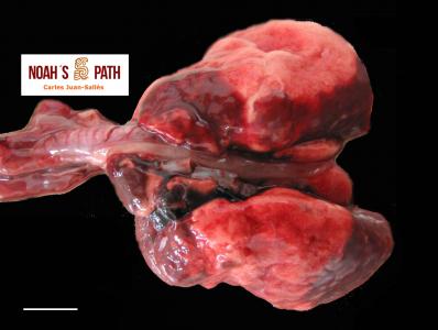 Bronconeumonía supurativa 