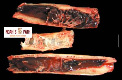 Hemorragia sacos aéreos intraóseos