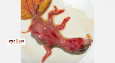 Hemorragias subcutáneas