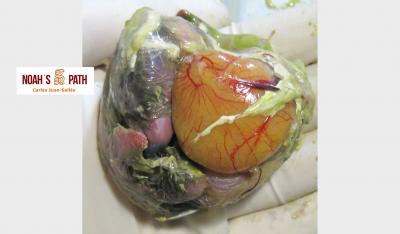 Malposición saco vitelino sobre cabeza y EPD