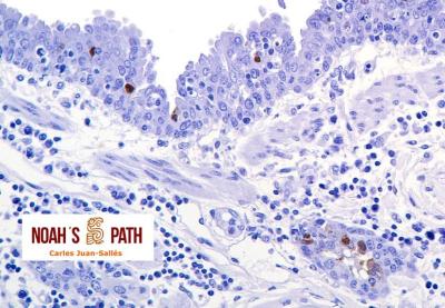 Marcaje antígeno influenza en neumonía bronquiolointersticial - Inmunohistoquímica virus de influenza A