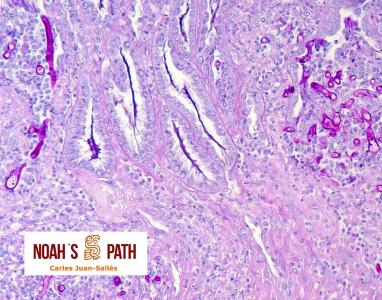 Ventriculitis por zygomicosis invasiva - tinción de PAS