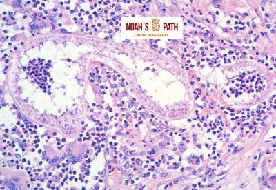 Colangiohepatitis hidatidosis alveolar