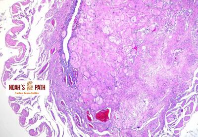 Coriocarcinoma uterino no gestacional