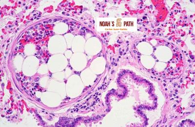 Embolismo de médula ósea en pulmón
