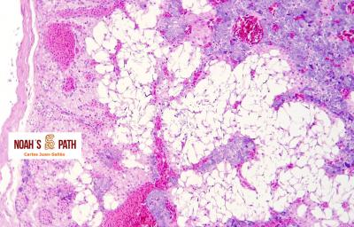 Respuesta estrés crónico - adrenal