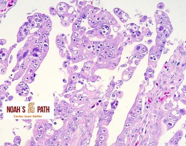 Enteritis proliferativa coccidiosis intranuclear