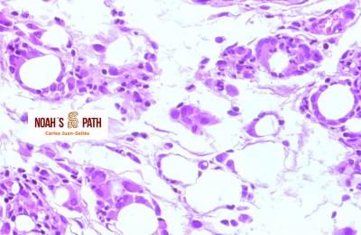 Esteatitis, deficiencia de vitamina E
