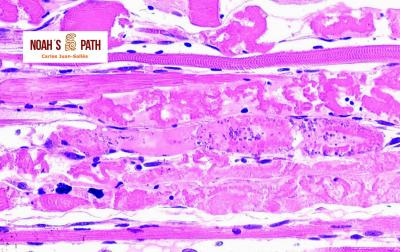 Rabdomionecrosis, deficiencia de vitamina E