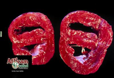 Hipertrofia concéntrica ventricular derecha, hipoxia de la altitud