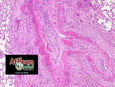Degeneración fibrinoide y arteriosclerosis (fibrosis transmural y periarterial) pulmonar, hipoxia de la altitud