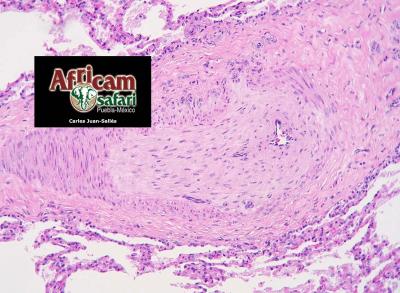 Arteriosclerosis (fibrosis transmural) pulmonar, hipoxia de la altitud