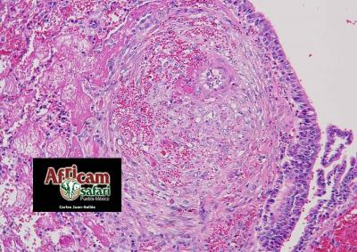 Degeneración fibrinoide, hemorragia e hiperplasia/hipertrofia mediales arteriales pulmonares, hipoxia de la altitud