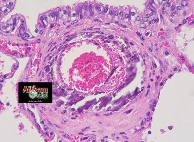 Mineralización y hemorragia mediales arteriales pulmonares, hipoxia de la altitud