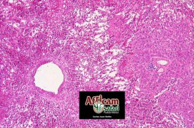 Congestión hepática pasiva crónica, insuficiencia cardiaca congestiva de lado derecho, hipoxia de la altitud