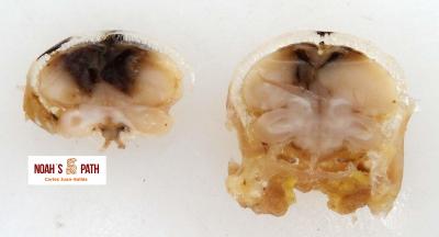 Encefalomalacia con hemorragia cerebral 