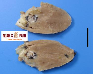 Endocarditis valvular bacteriana, PBFD 