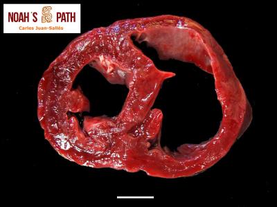 Cardiomiopatía dilatada biventricular