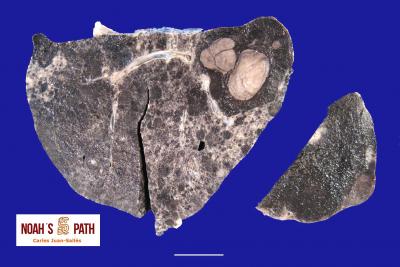 Melanoma metastático