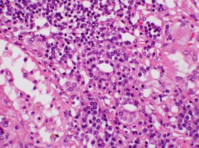 Nefritis crónica - leptospirosis 