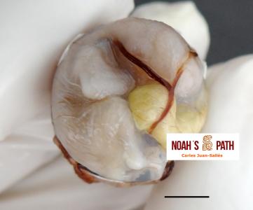 Malposición embrionaria (cabeza girada a izquierda, eje axial disposición horizontal, saco vitelino desplazado dorsalmente)