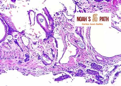Adenocarcinoma intestinal
