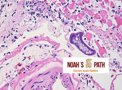 Rabdomionecrosis y pericarditis fibrinosa por trematodiasis