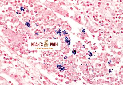 Nefritis por microsporidios, tinción de Gram