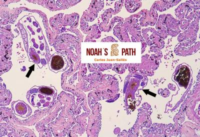Nematodiasis pulmonar (<i>Rhabdias</i>)