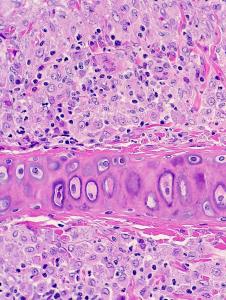 Otitis externa granulomatosa debida a leishmaniasis