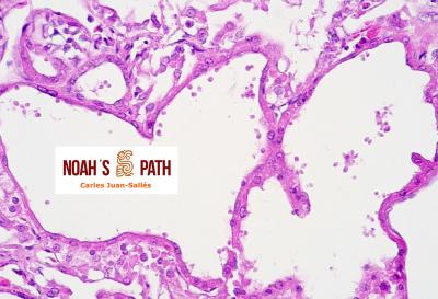 Dilatación tubular renal con infección luminal por flagelados