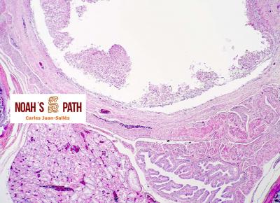 Cloacitis con infección cloacal invasiva (y renal ascendente) por flagelados