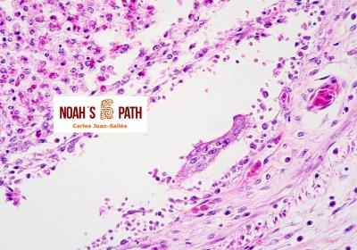 Cloacitis con infección cloacal invasiva por flagelados