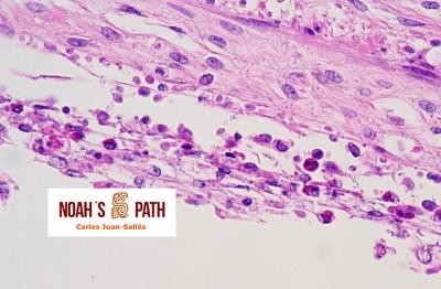 Cloacitis con infección cloacal invasiva por flagelados